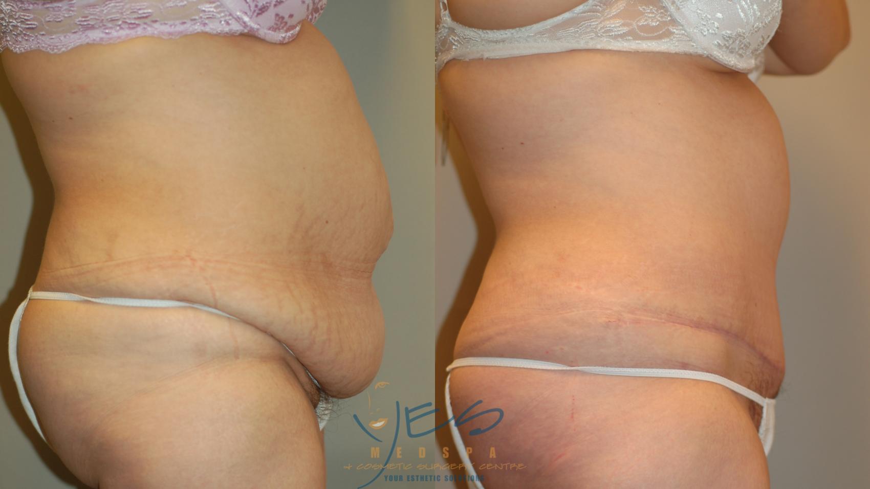 Before & After Tummy Tuck Case 36 Right Side View in Vancouver, BC