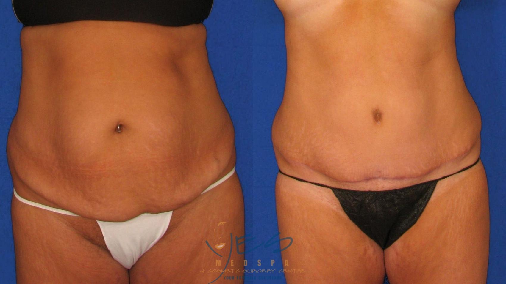 Before & After Tummy Tuck Case 37 Front View in Vancouver, BC