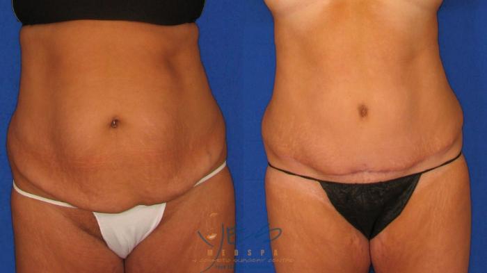 Before & After Tummy Tuck Case 37 Front View in Vancouver, BC