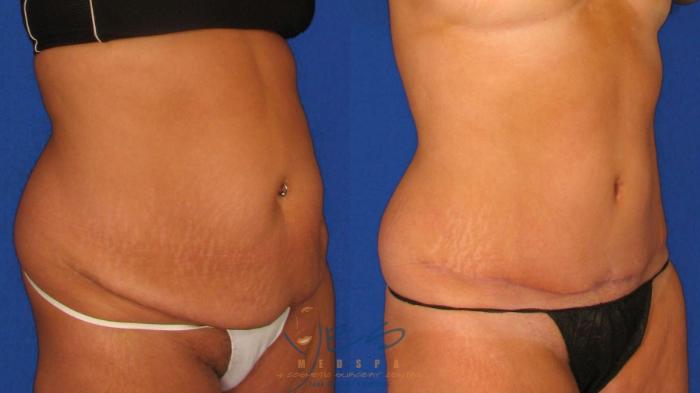 Before & After Tummy Tuck Case 37 Right Oblique View in Vancouver, BC