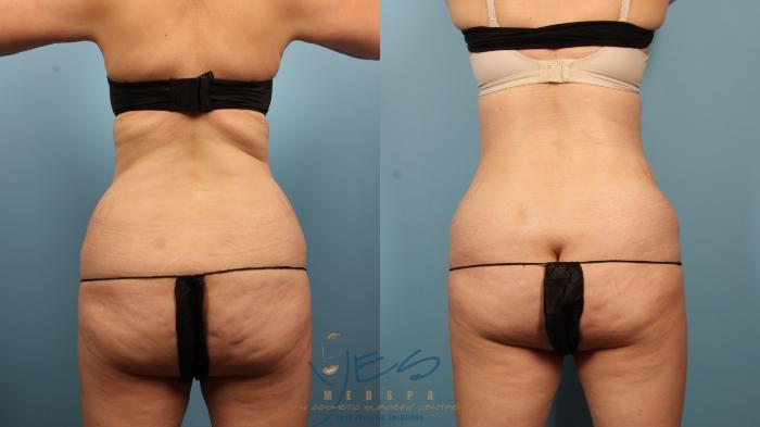 Before & After Liposuction Case 374 Back View in Vancouver, BC