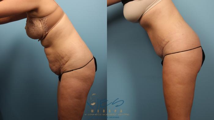 Before & After Tummy Tuck Case 374 Diver's pose View in Vancouver, BC