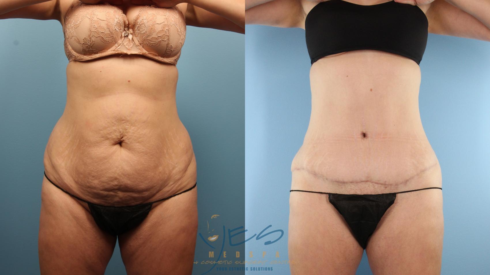 Before & After Tummy Tuck Case 374 Front View in Vancouver, BC