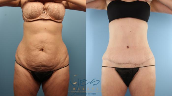 Before & After Liposuction Case 374 Front View in Vancouver, BC