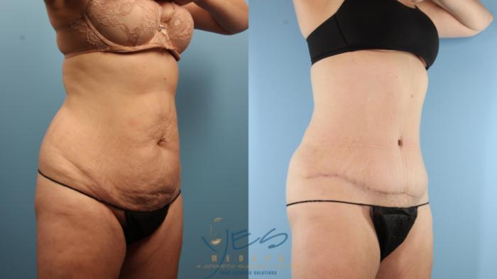 Before & After Tummy Tuck Case 374 Right Oblique View in Vancouver, BC