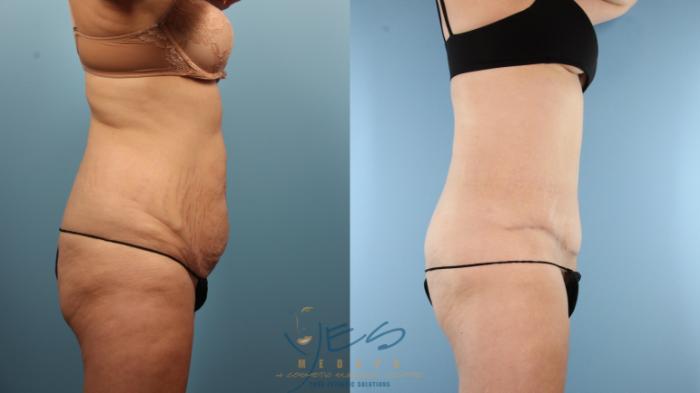 Before & After Tummy Tuck Case 374 Right Side View in Vancouver, BC