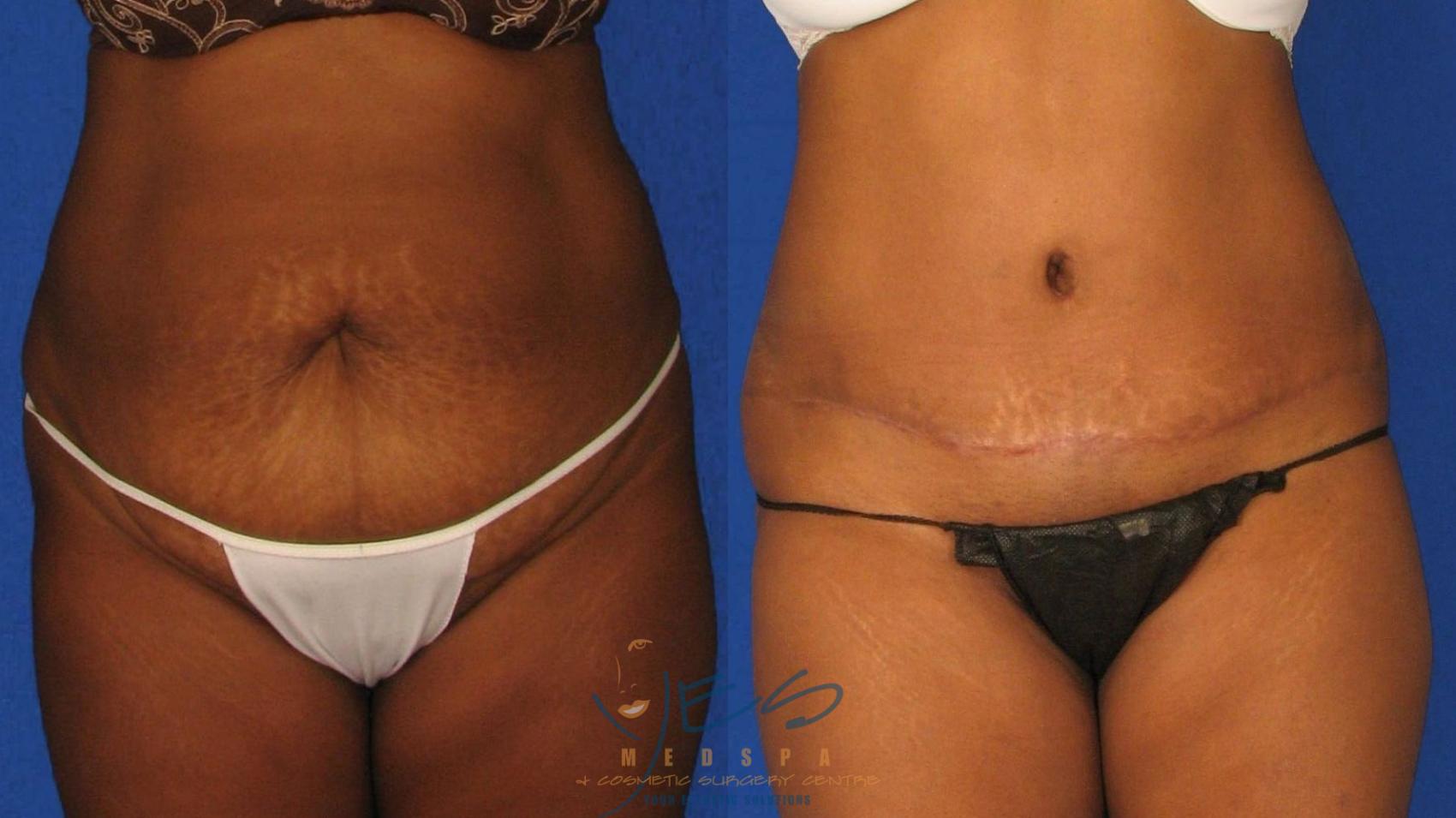 Before & After Tummy Tuck Case 38 Front View in Vancouver, BC