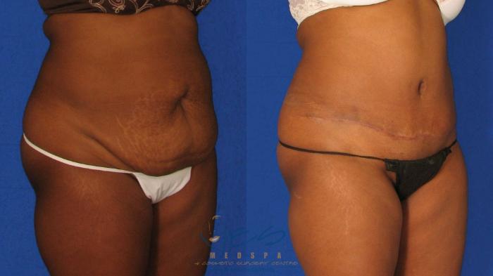 Before & After Tummy Tuck Case 38 Right Oblique View in Vancouver, BC