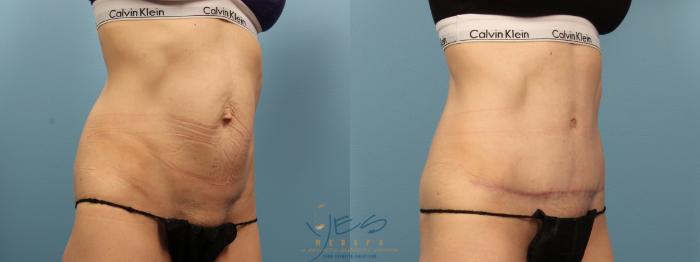 Before & After Tummy Tuck Case 381 Right Oblique View in Vancouver, BC