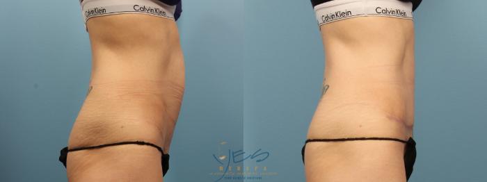 Before & After Tummy Tuck Case 381 Right Side View in Vancouver, BC