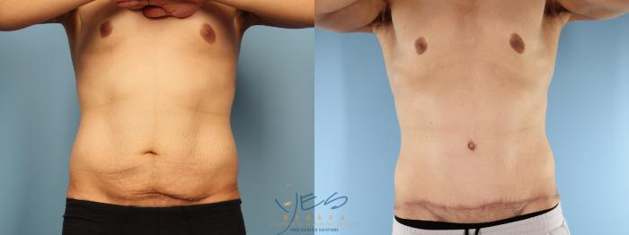 Before & After Tummy Tuck Case 384 Front View in Vancouver, BC