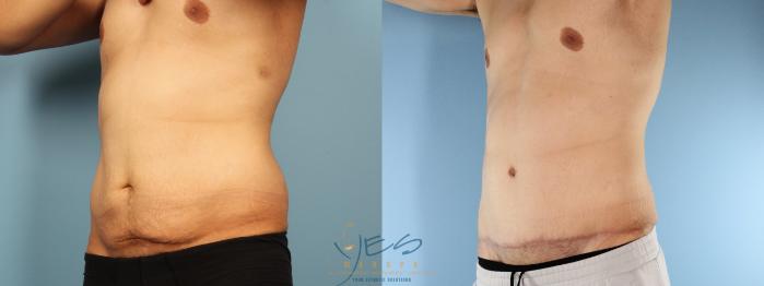 Before & After Tummy Tuck Case 384 Left Oblique View in Vancouver, BC