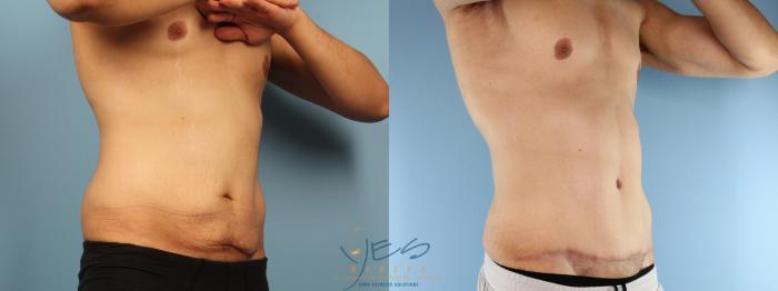 Before & After Tummy Tuck Case 384 Right Oblique View in Vancouver, BC