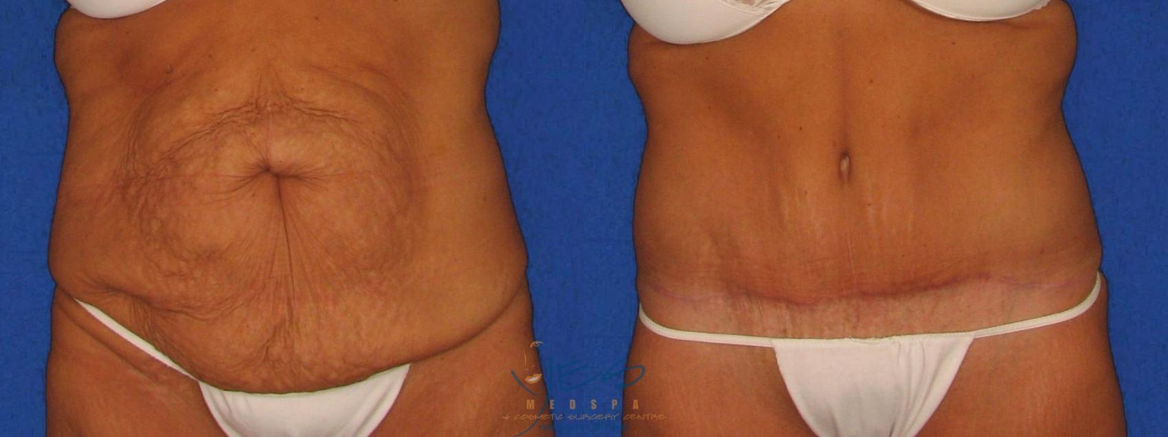 Before & After Tummy Tuck Case 39 Front View in Vancouver, BC