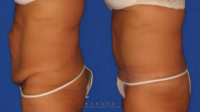 Before & After Tummy Tuck Case 39 Left Side View in Vancouver, BC