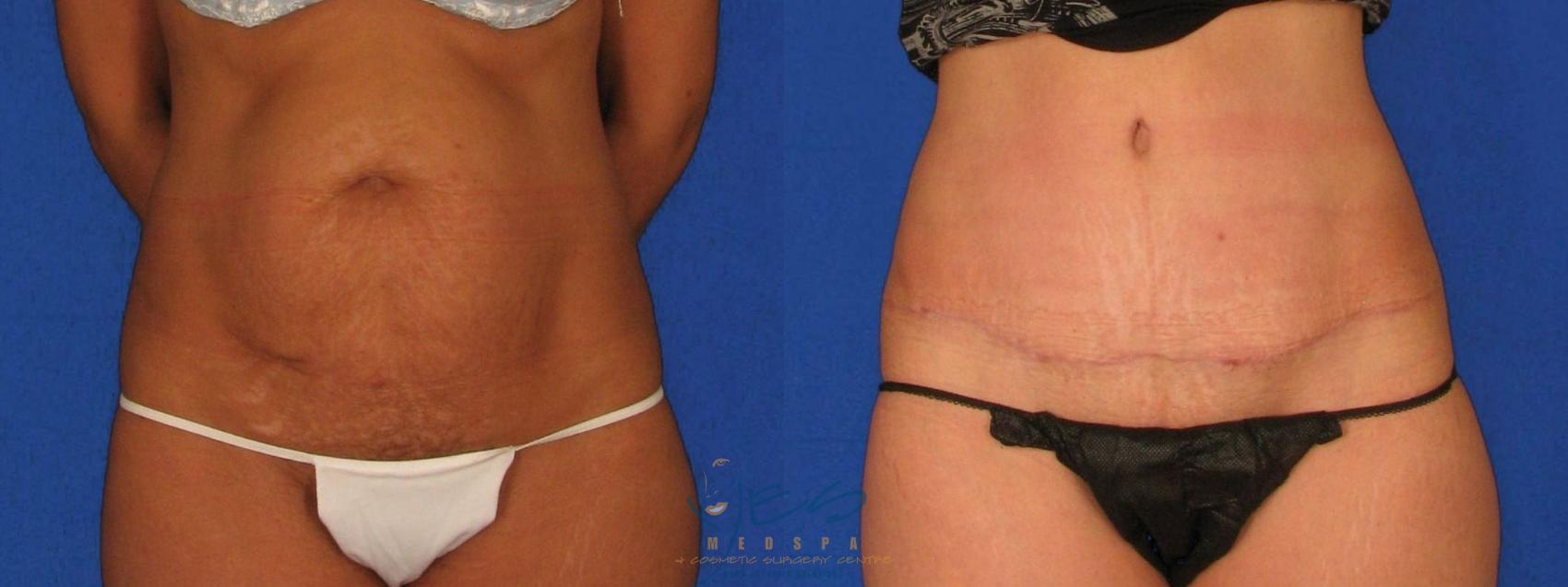 Before & After Tummy Tuck Case 40 Front View in Vancouver, BC