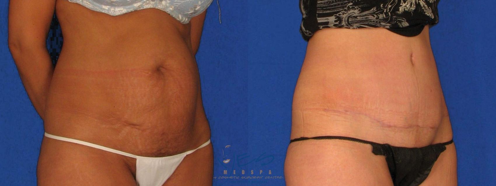 Before & After Tummy Tuck Case 40 Right Oblique View in Vancouver, BC