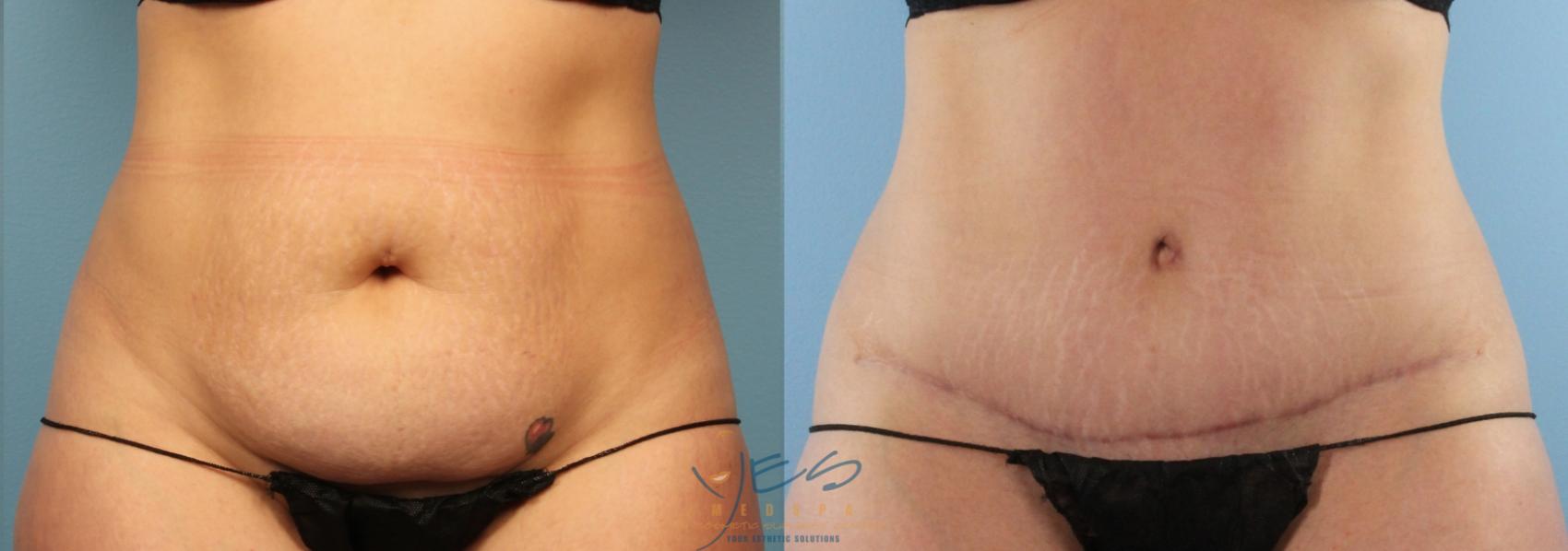 Before & After Tummy Tuck Case 442 Front View in Vancouver, BC
