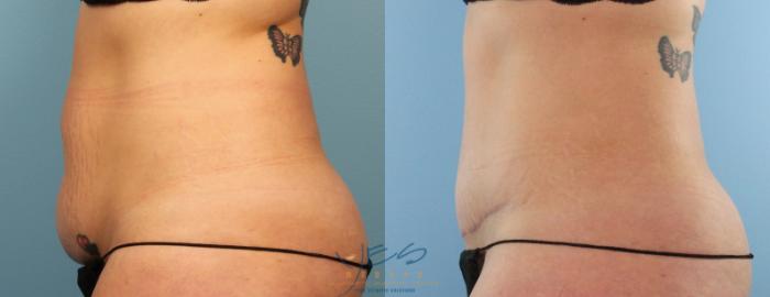 Before & After Tummy Tuck Case 442 Left Side View in Vancouver, BC