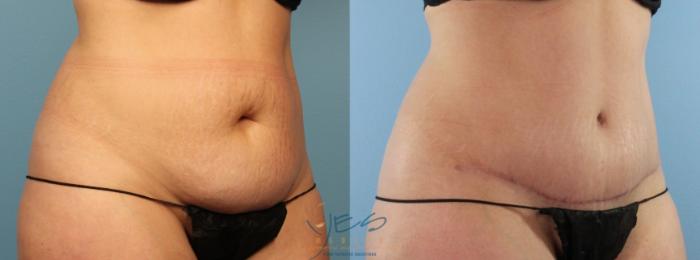 Before & After Tummy Tuck Case 442 Right Oblique View in Vancouver, BC