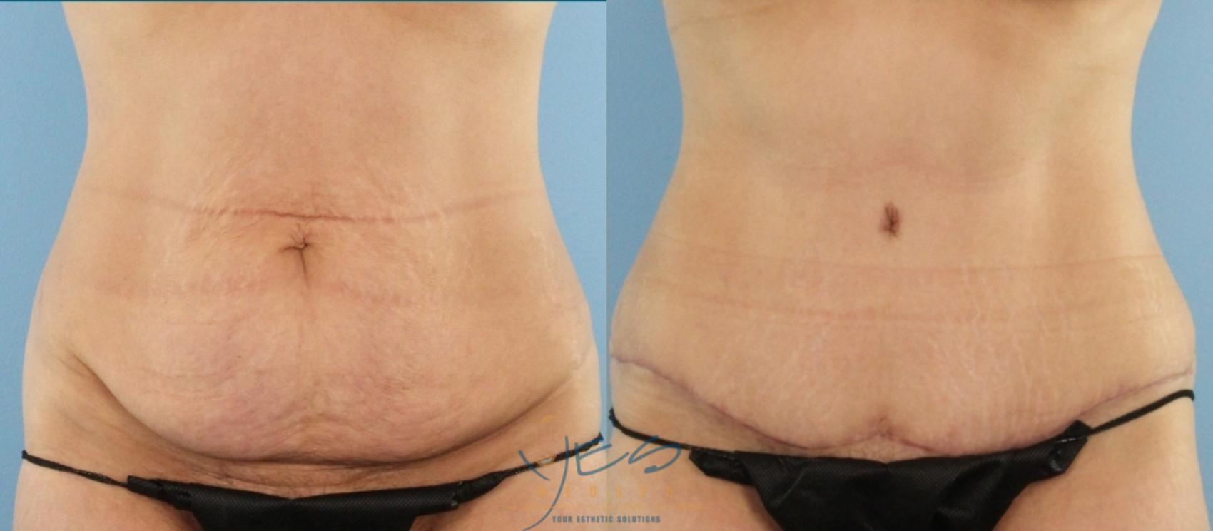 Before & After Tummy Tuck Case 445 Front View in Vancouver, BC