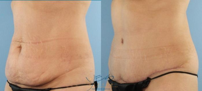 Before & After Tummy Tuck Case 445 Left Oblique View in Vancouver, BC