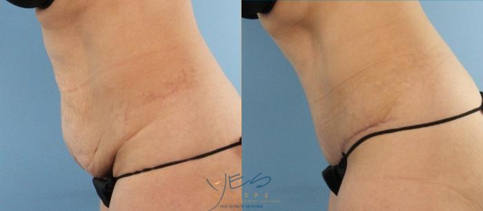 Before & After Tummy Tuck Case 445 Left Side View in Vancouver, BC