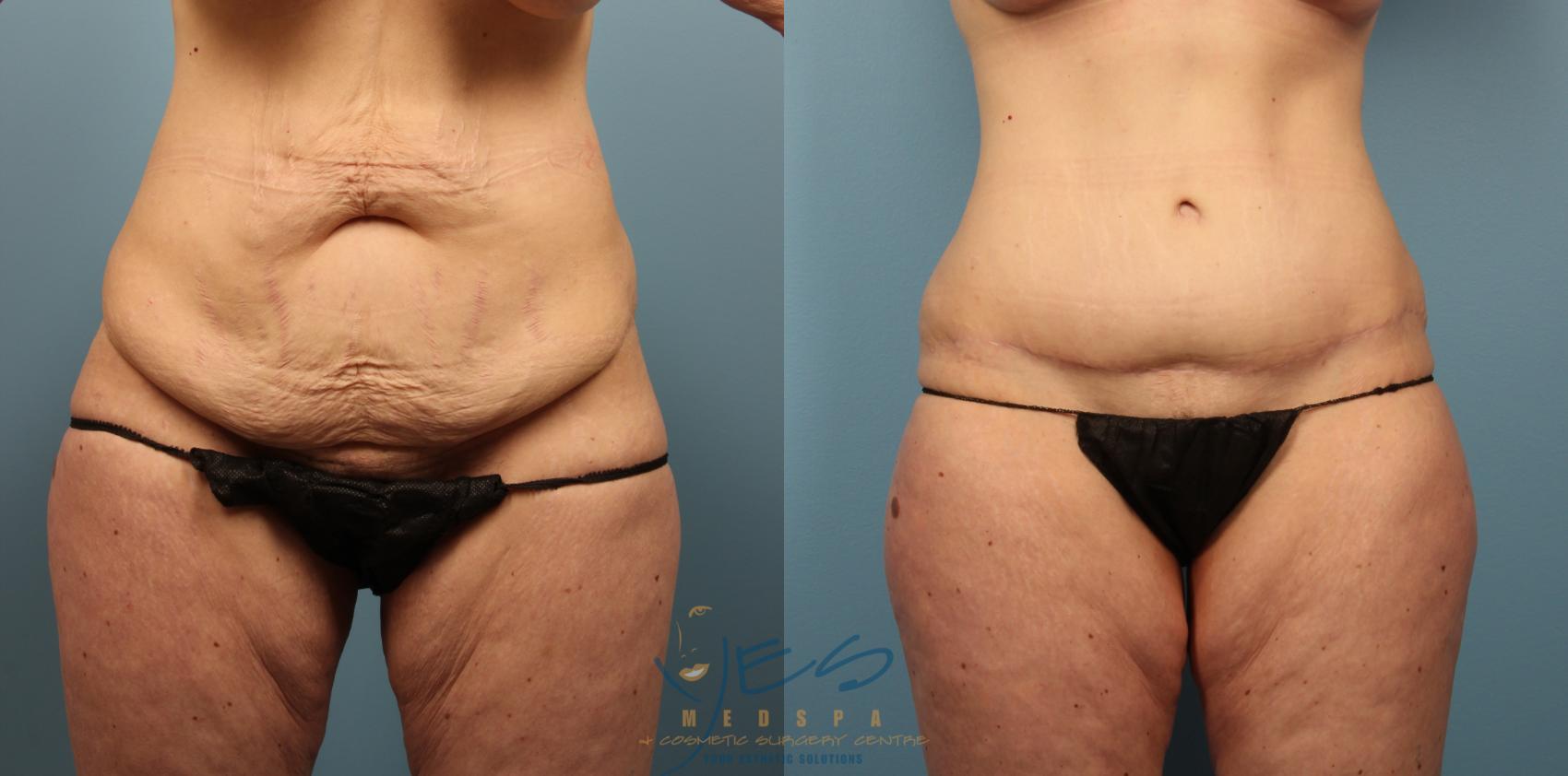 Before & After Tummy Tuck Case 488 Front View in Vancouver, BC