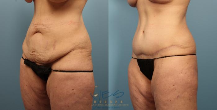 Before & After Tummy Tuck Case 488 Left Oblique View in Vancouver, BC