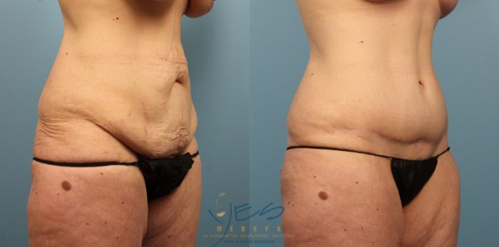 Before & After Tummy Tuck Case 488 Right Oblique View in Vancouver, BC
