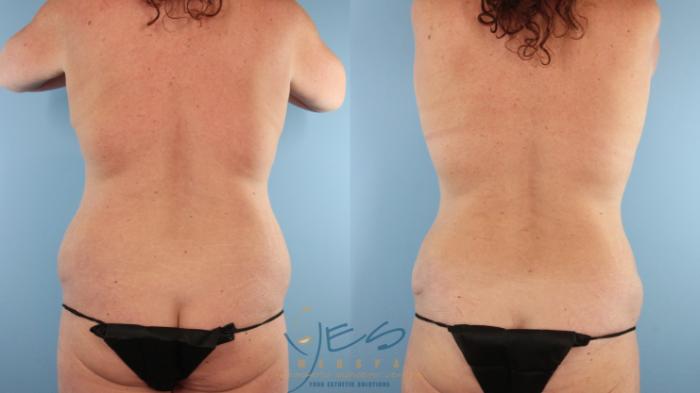 Before & After Liposuction Case 493 Back View in Vancouver, BC