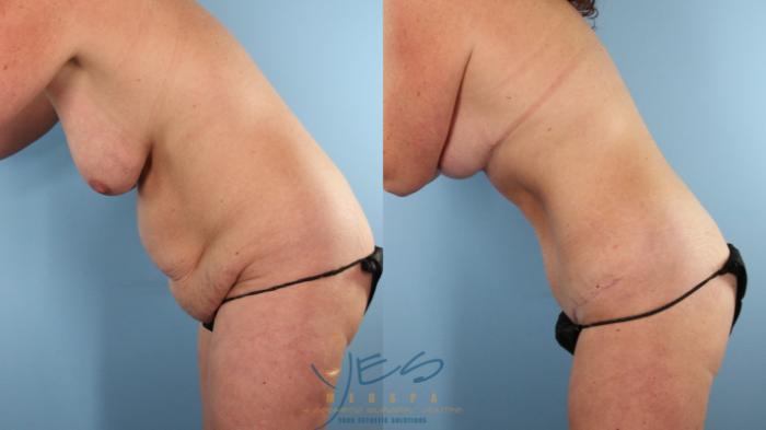 Before & After Liposuction Case 493 Diver's Pose View in Vancouver, BC