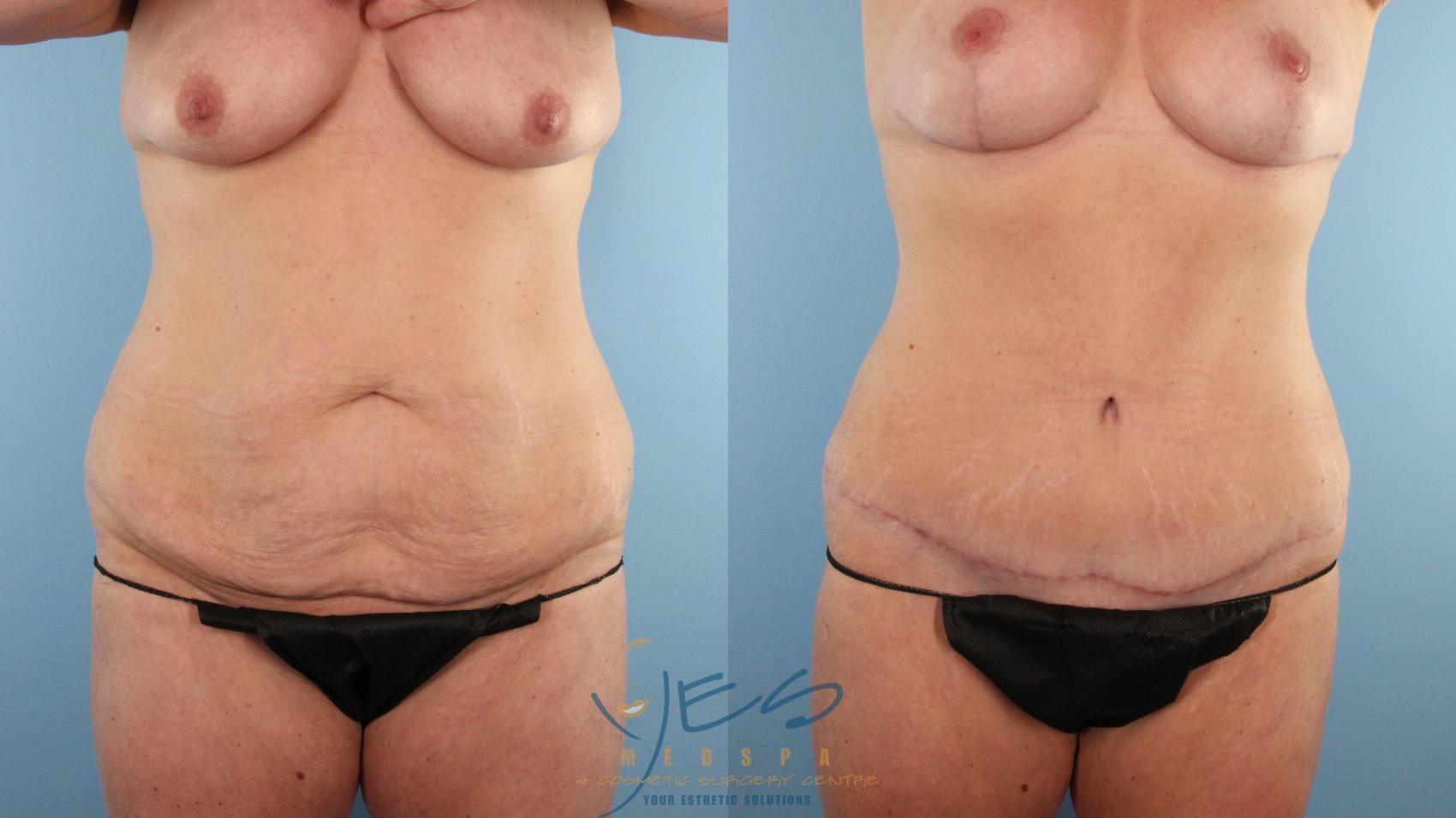 Tummy Tuck Before & After Photos Patient 27, Vancouver, BC