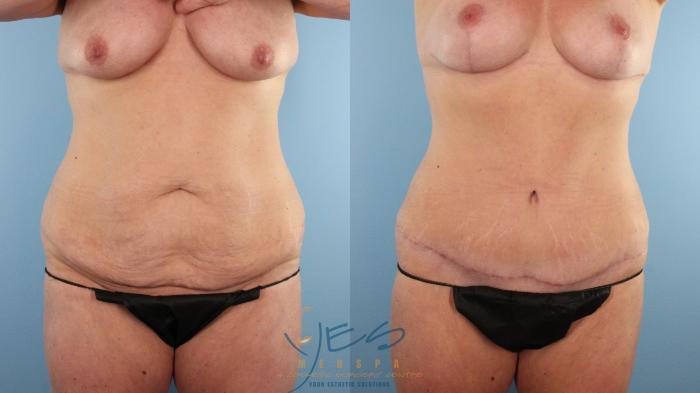 Before & After Tummy Tuck Case 493 Front View in Vancouver, BC