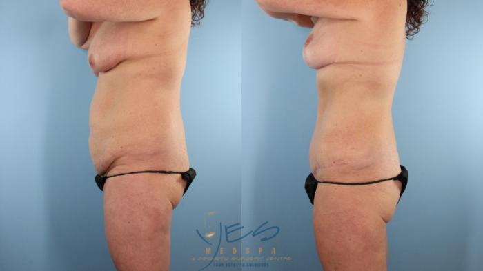 Before & After Tummy Tuck Case 493 Left Side View in Vancouver, BC