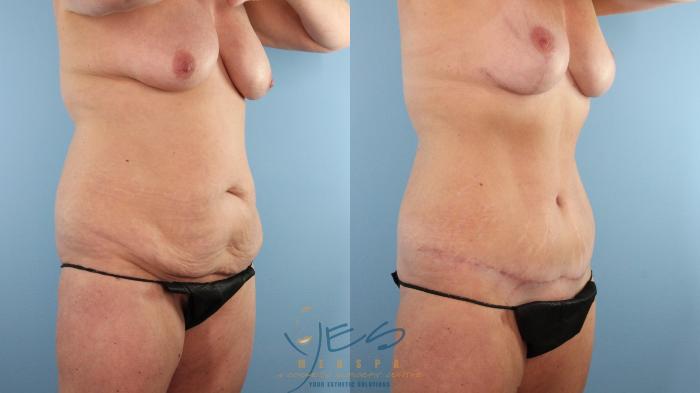 Before & After Liposuction Case 493 Right Oblique View in Vancouver, BC