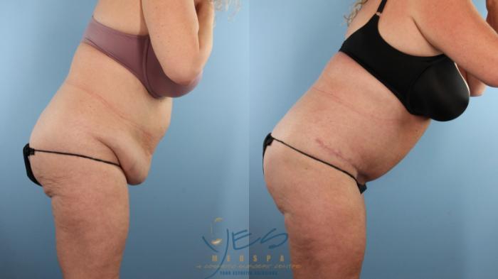 Before & After Liposuction Case 498 Diver's Pose View in Vancouver, BC