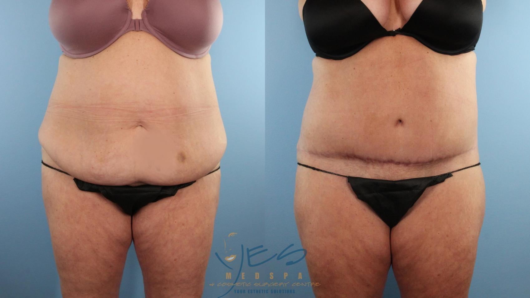 Before & After Liposuction Case 498 Front View in Vancouver, BC