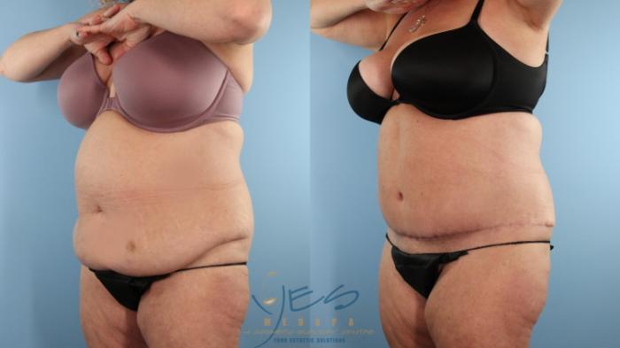 Before & After Tummy Tuck Case 498 Right Oblique View in Vancouver, BC