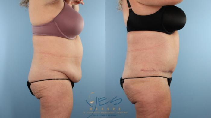 Before & After Tummy Tuck Case 498 Right Side View in Vancouver, BC