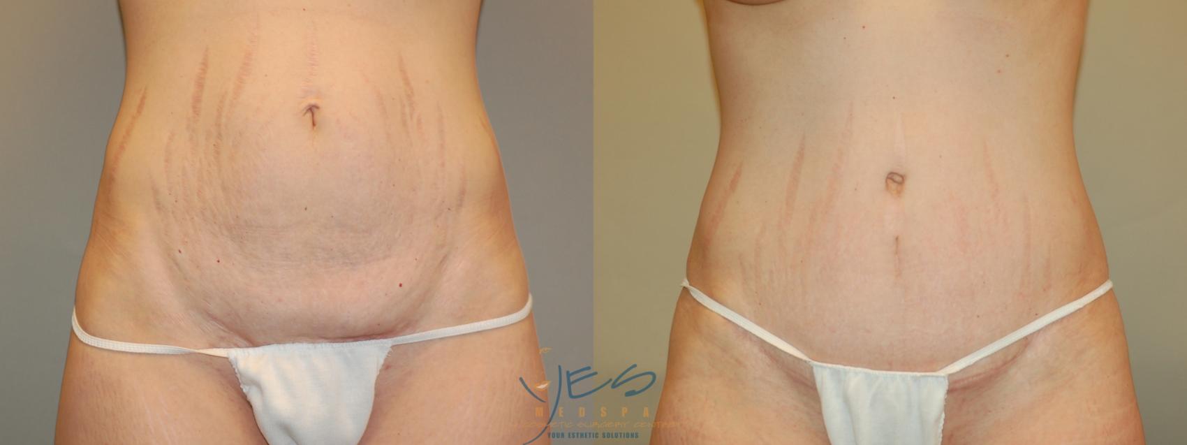 Before & After Tummy Tuck Case 5 Front View in Vancouver, BC