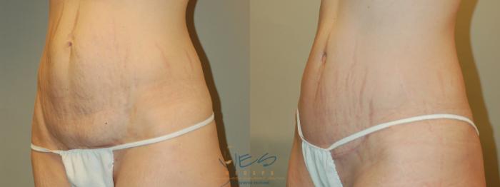 Before & After Tummy Tuck Case 5 Left Oblique View in Vancouver, BC