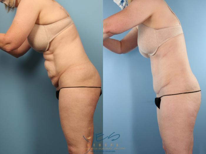 Before & After Tummy Tuck Case 501 Divers pose View in Vancouver, BC