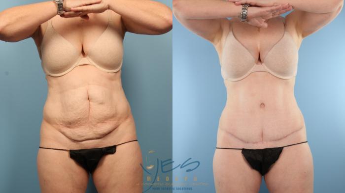 Before & After Tummy Tuck Case 501 Front View in Vancouver, BC