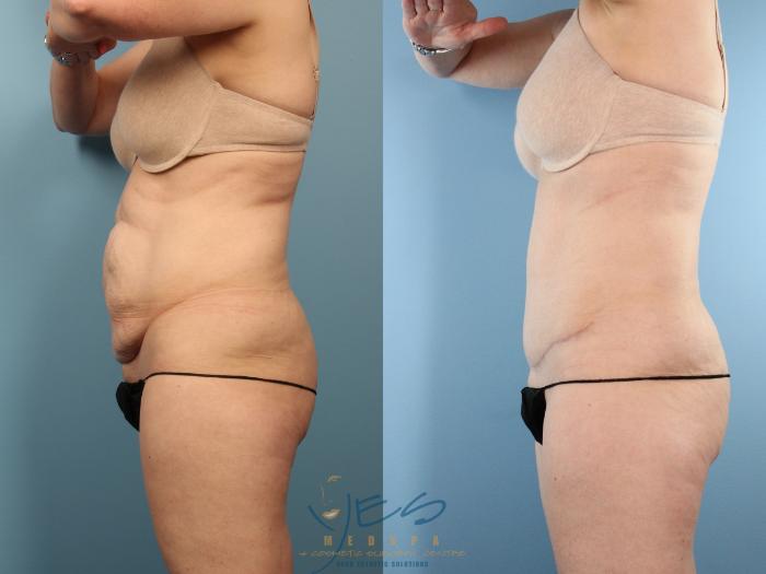 Before & After Tummy Tuck Case 501 Left Side View in Vancouver, BC