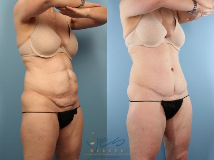 Before & After Tummy Tuck Case 501 Right Oblique View in Vancouver, BC