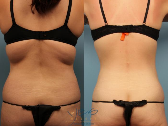 Before & After Tummy Tuck Case 503 Back View in Vancouver, BC