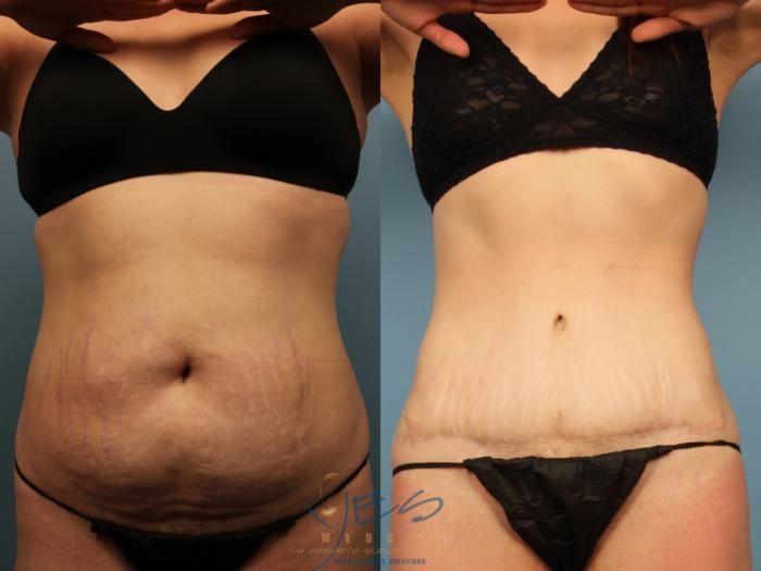 Before & After Tummy Tuck Case 503 Front View in Vancouver, BC