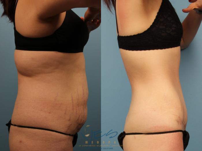 Before & After Tummy Tuck Case 503 Left Side View in Vancouver, BC