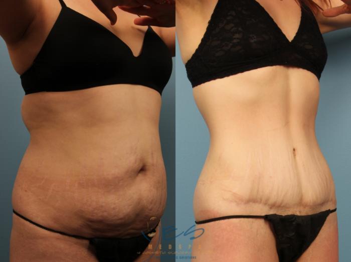 Before & After Tummy Tuck Case 503 Right Oblique View in Vancouver, BC